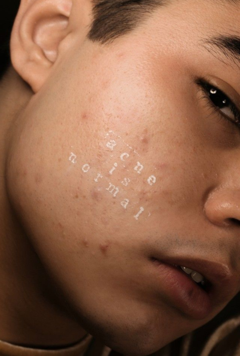 ​NORMALIZING ACNE + TIPS FOR CLEAR SKIN